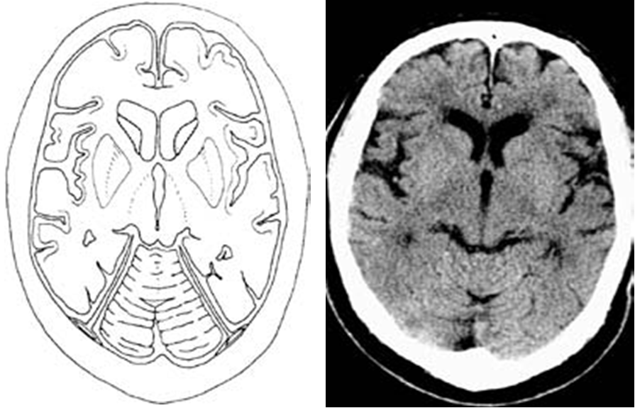 Skull Fracture Symptoms 10. Intracranial vessels - No abnormal dilatation, No vascular -4.bp.blogspot.com