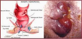 Wasir Saat Hamil Wasir Saat Hamil