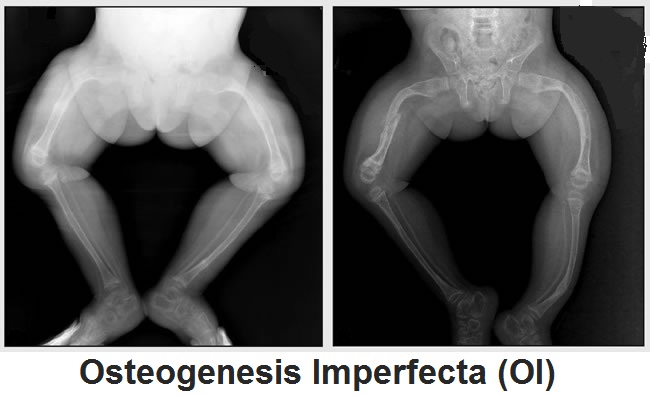 Osteogenesis Imperfecta (OI Disease): Types, Symptoms, Diagnosis And