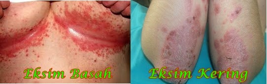 Eksim Basah Dan Kering Eksim Basah Dan Kering
