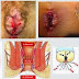 Obat Anti Wasir Berdarah Selain AMBEVEN thumbnail