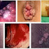 Cara Herbal Obati Wasir Berdarah thumbnail