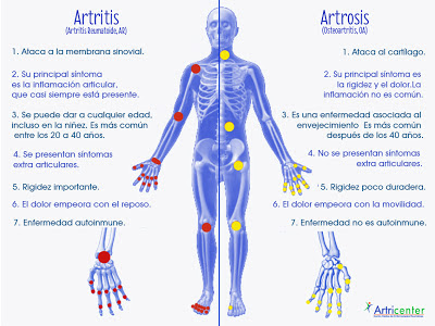 diferencias-entre-artritis-y-artrosis1.jpg