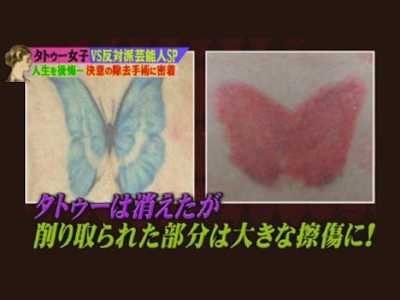 tortuosa remoção de tatuagem no Japão