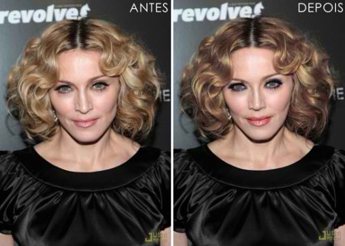 stars before after botox