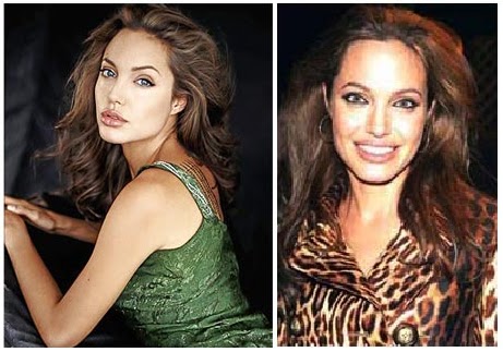 Celebritie's Plastic Surgical Treatment Before and After Celebritie's Plastic Surgical Treatment Before and After