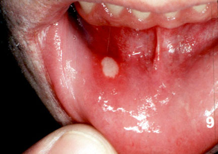Biting Inside Cheek