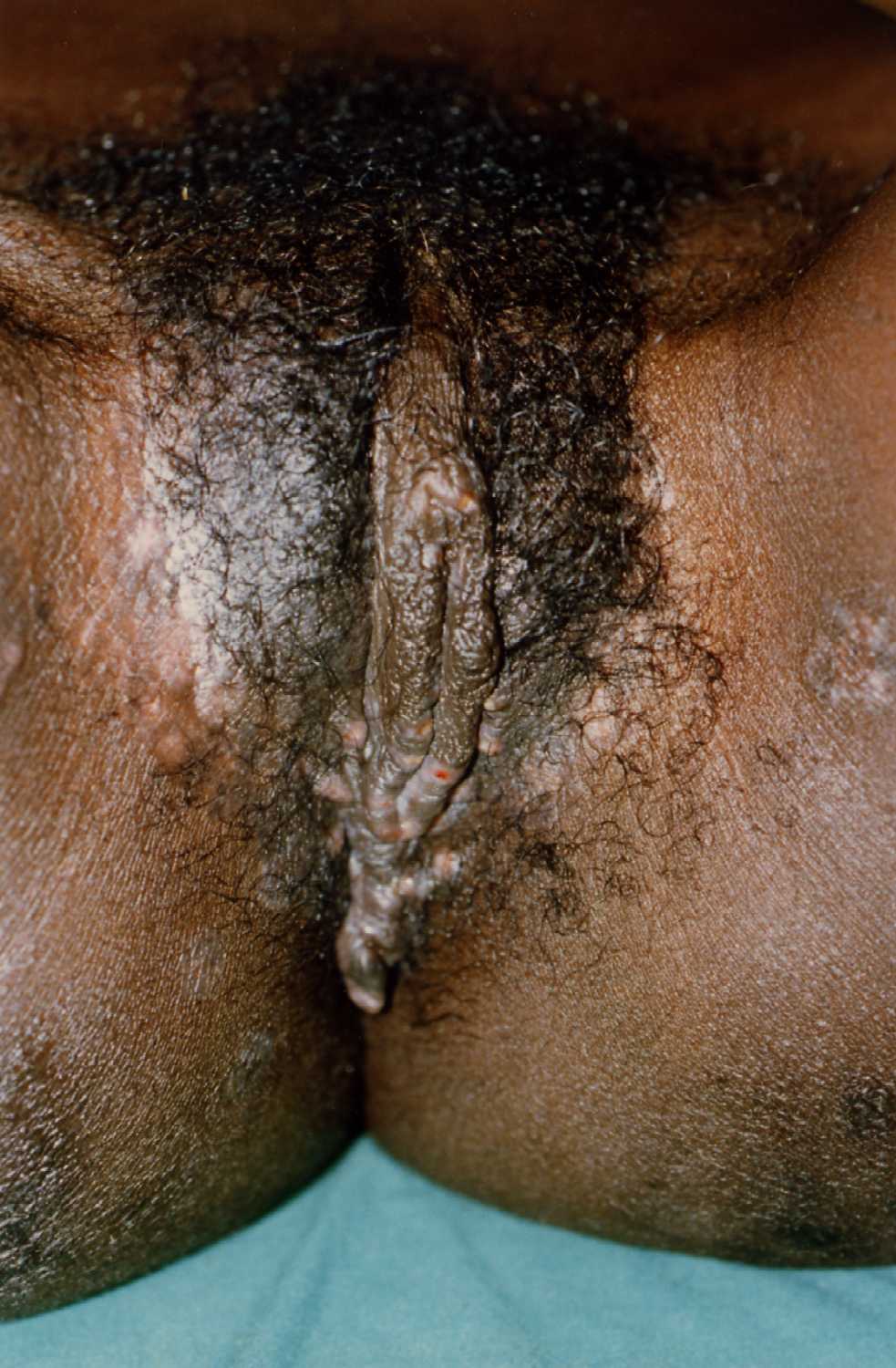 uncut dick fetish std pictures women pussy
