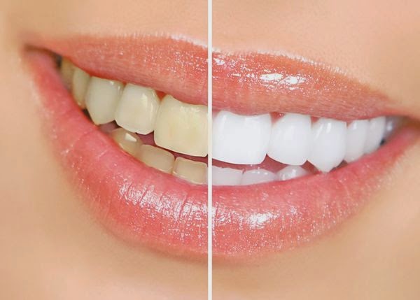 como blanquear los dientes como blanquear los dientes