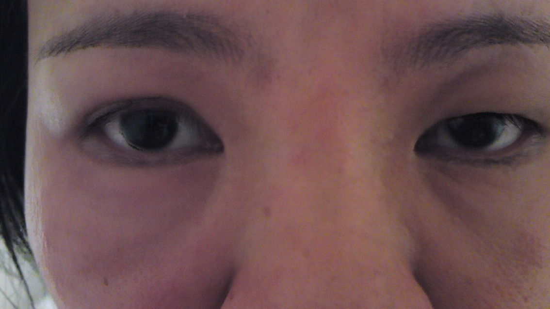 eye swollen swollen eye swollen swollen