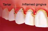 que es gingivitis que es gingivitis