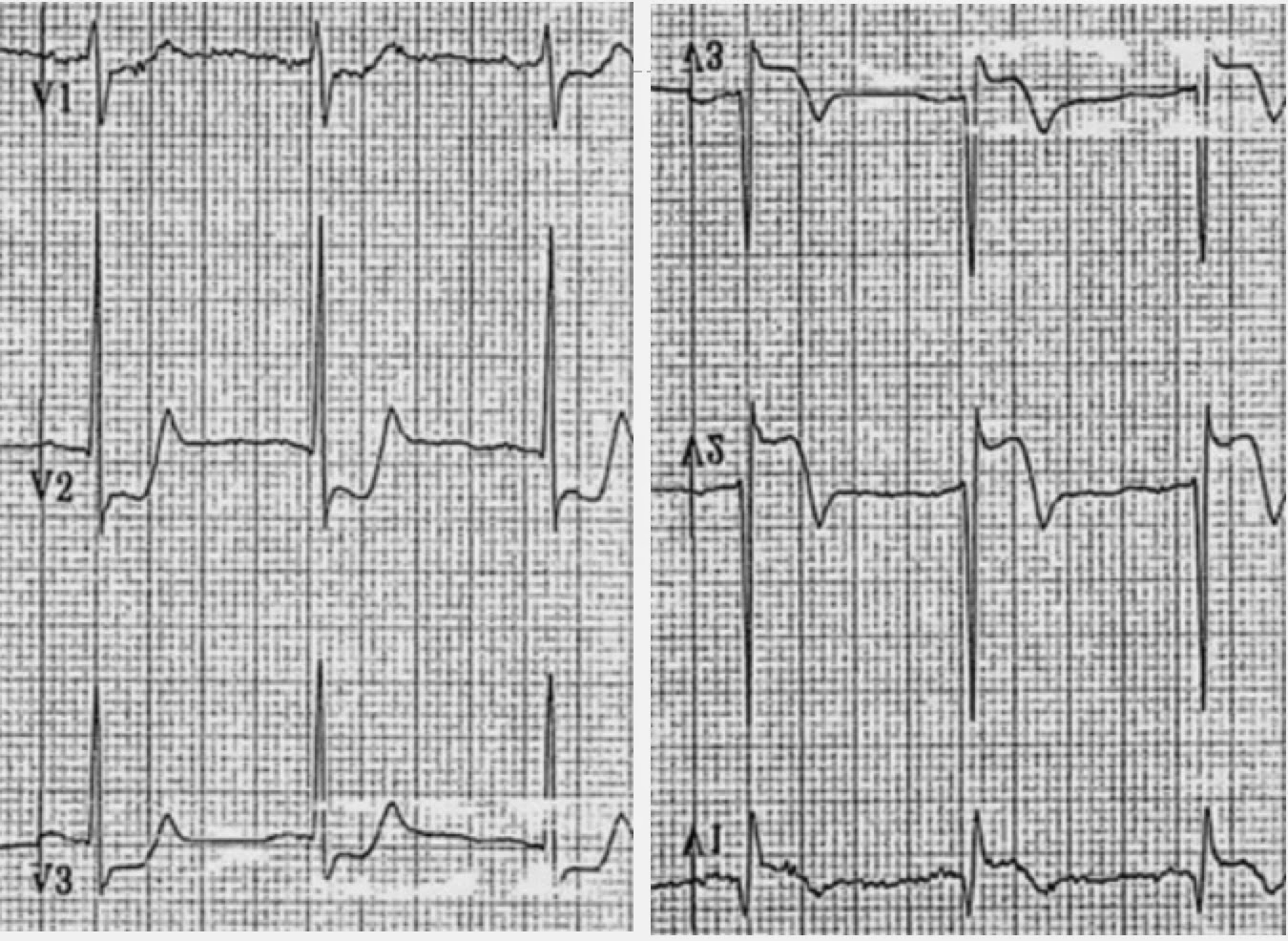 Mill Hill Ave Command New thoughts on posterior MI for EMS