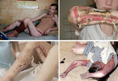 Krokodil Drug Narkoba Jenis Baru Krokodil Drug