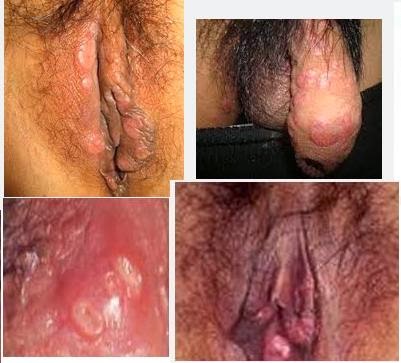 Image Mengenal Penyakit Kelamin Sifilis | Obat sifilis herbal