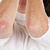 How To Treat Psoriasis With Tamanu Oil | Tamanu Oil For Psoriasis