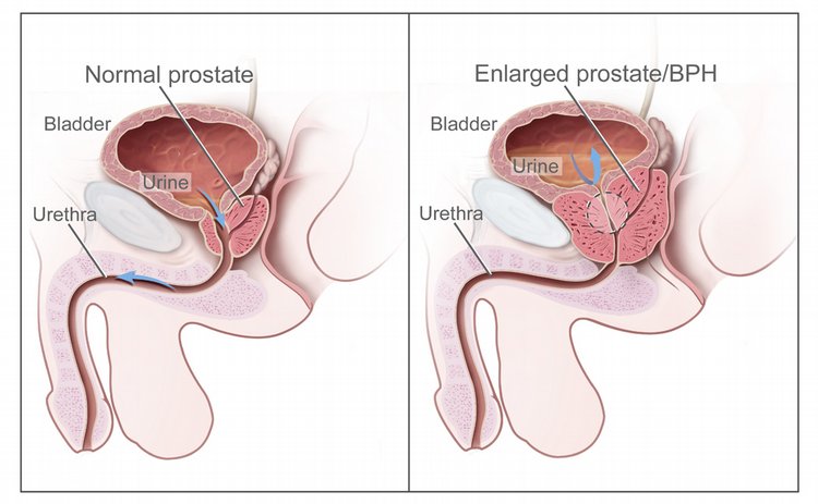 Benign Prostatic Hyperplasia (BPH)