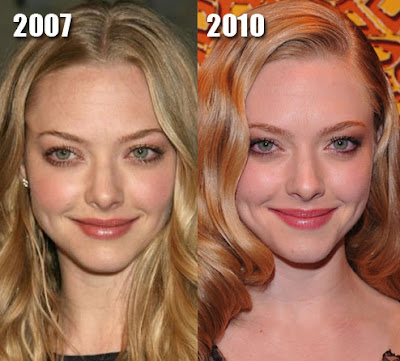 Amanda-Seyfried-Botox-Injection-Before-After.jpg