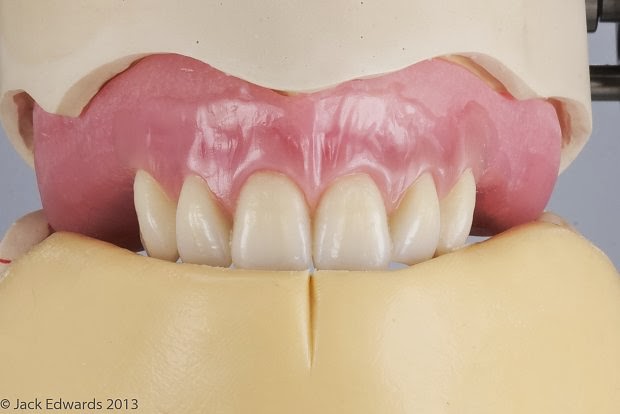 teeth setting