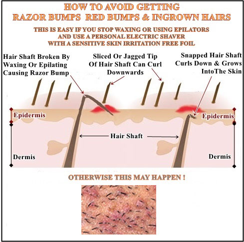 How To Remove A Hair Bump From A Womens Private | the wizard of fuzz offers painless inexpensive hair How To Remove A Hair Bump From A Womens Private | the wizard of fuzz offers painless inexpensive hair