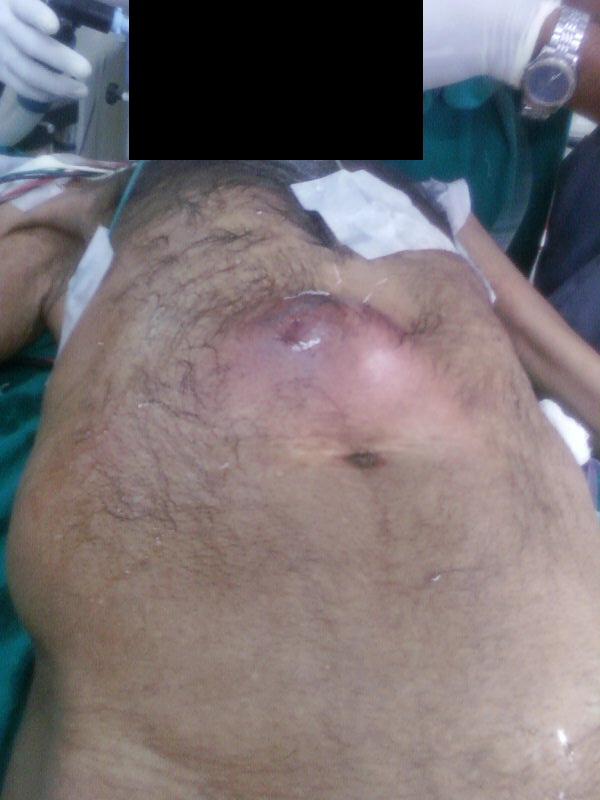 Hernia Epigastric