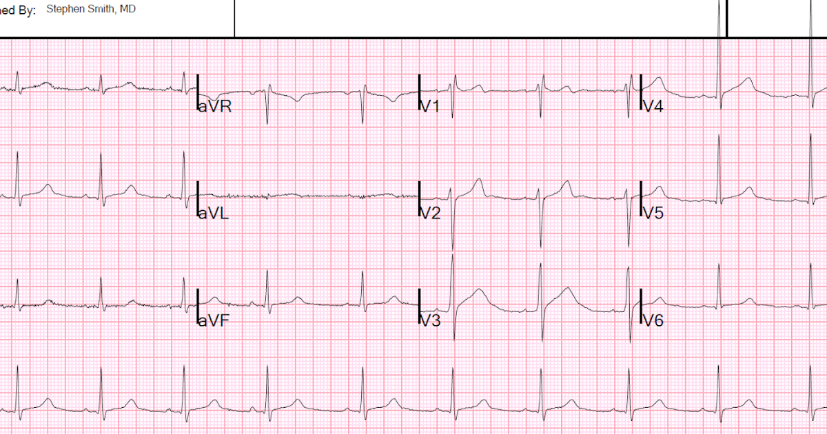 Sudden Dizziness And Nausea And Sweating Ringing Sudden Dizziness And Nausea And Sweating Ringing