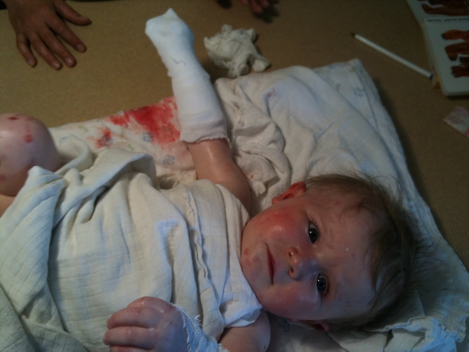 Needle Accident