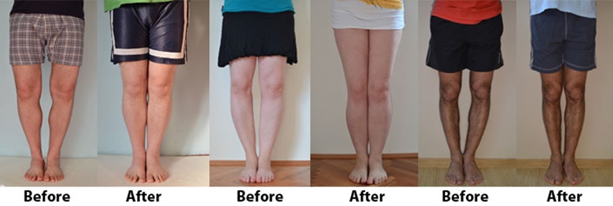 Bow Legs No More - How to Straighten Your Legs Without Surgery