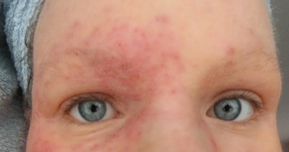 I Have Eczema Eczema Herpeticum Round 9