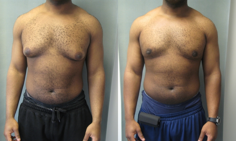 exemple de gynecomastie