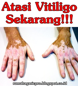 Obat Vitiligo Obat Vitiligo