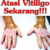 Cara Mengatasi Vitiligo Secara Alami Dan Aman