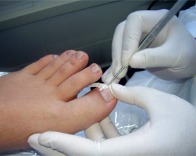 Tratamentos de podologia