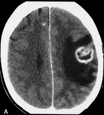 Cns Tuberculoma