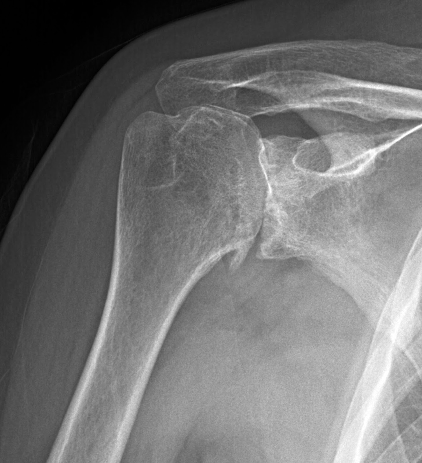 Shoulder Arthritis / Rotator Cuff Tears causes of shoulder pain