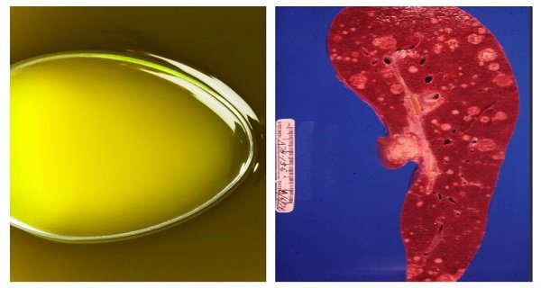 New Study Revealed That This OIL Kills Cancer Cells Within MINUTES! New Study Revealed That This OIL Kills Cancer Cells Within MINUTES!
