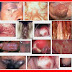 Obat Tradisional Kencing Nanah thumbnail