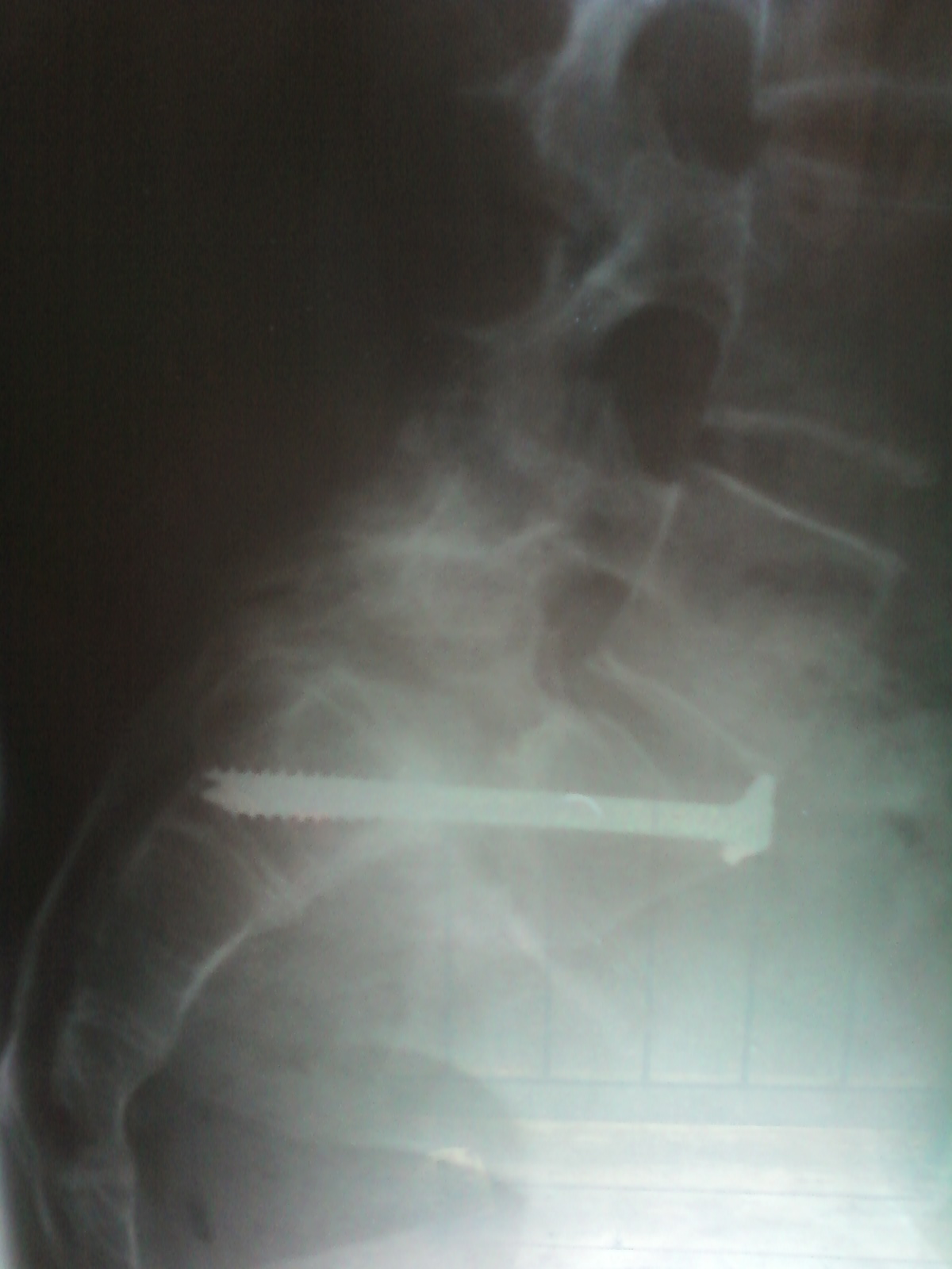 Spondylolthesis and traction