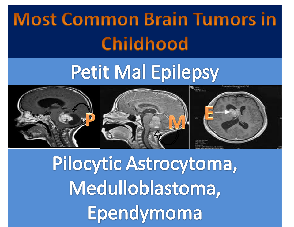 USMLE to Residency Videos, Updates & More!! Most Common Brain Tumors