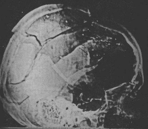 JFK-Xray-Lateral.jpg