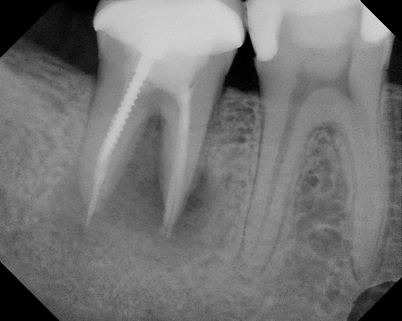 The Endo Blog: Saving a Tooth with Intentional Replantation