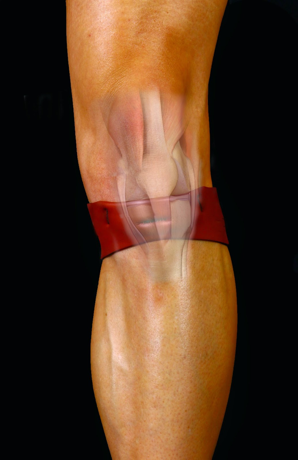 Treatment of Osgood Schlatters with knee band or knee support brace