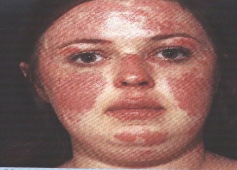 LUPUS ERITEMATOSO TRATAMIENTO lupus eritematoso tratamiento: