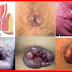 Obat Apotik Herbal Mengobati Ambeyen Berdarah thumbnail