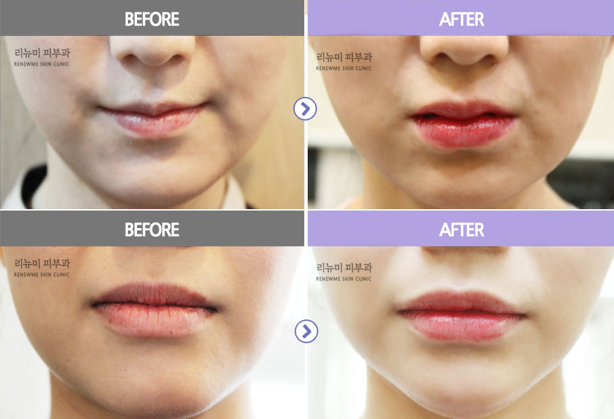 Renewme Skin Clinic Get Full & Luscious Lips with a Simple Filler