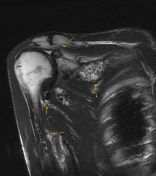 Synovial chondromatosis MRI Sumer's Radiology Blog
