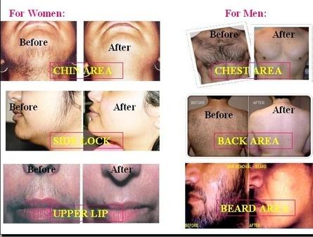 Natural Permanent Hair Removal 08152054136 Natural Permanent