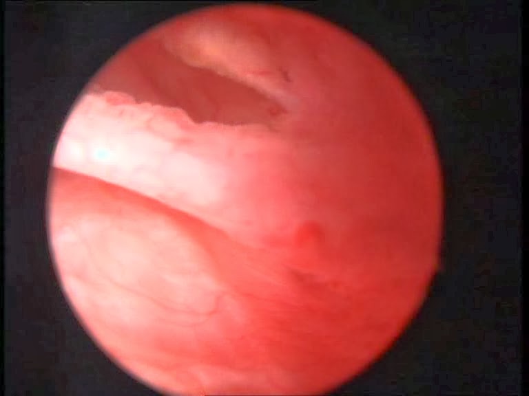 artroscopia rodilla perro imagen artroscopica del ligamento
