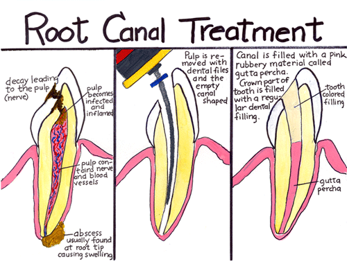 Tooth Fracture-4.bp.blogspot.com Root Canal Treatment