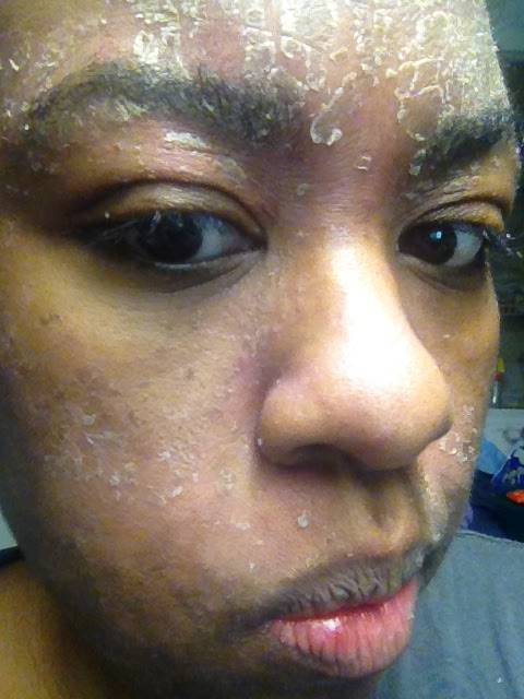 Laurel S Blog Warning The Famous Proactiv Skin Cleanser Ruined My Skin