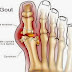 How Can Solve The Gout Problem